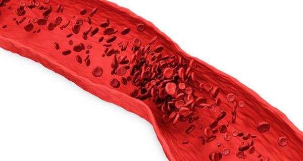 研究人员用3D打印微流体血管模型来研究动脉血栓形成的原因